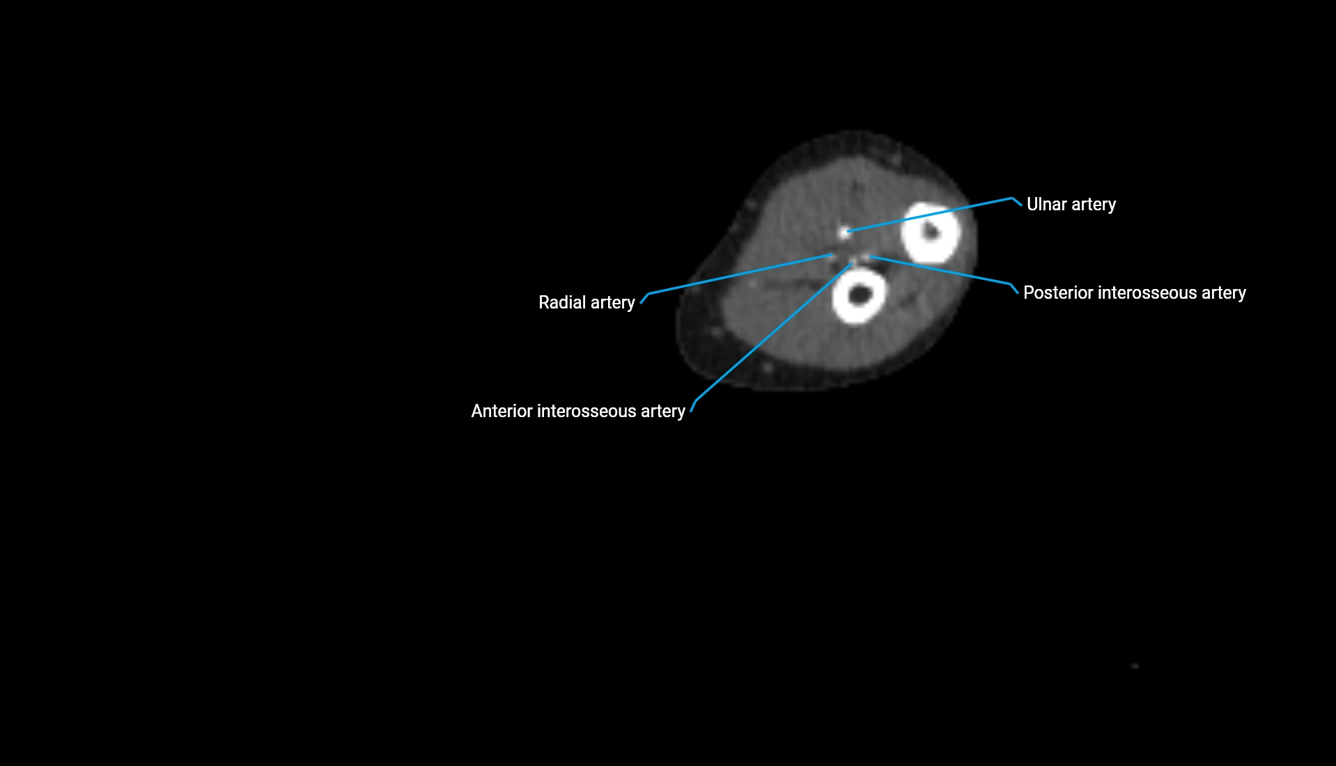 CTA upper limb axial cross sectional anatomy labelled image 163 (2).webp